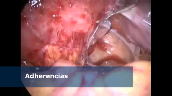 Adherencias