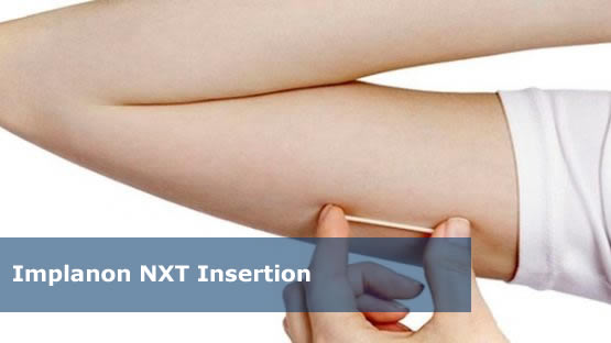 nexplanon