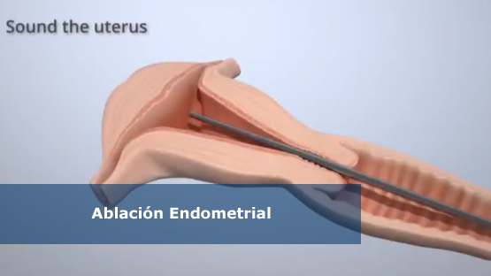 ablacion_endometrial
